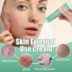 HBESTY ACNE REMOVER CREAM - Image 2