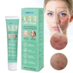 HBESTY ACNE REMOVER CREAM - Image 3